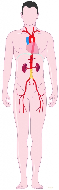 Occlusie van de aorta + bekkenslagader 